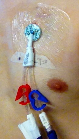 A dialysis two-lumen catheter inserted on the person's left side. Scars at the base of the neck indicate the insertion point into the left jugular vein.